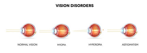 Vision Correction